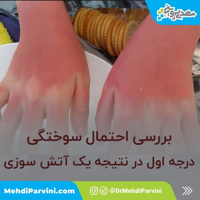 بررسی احتمال سوختگی با PHAST